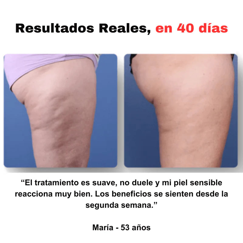 Masajeador anticelulítico
