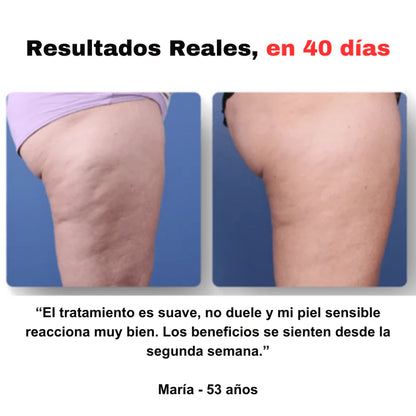 Masajeador anticelulítico
